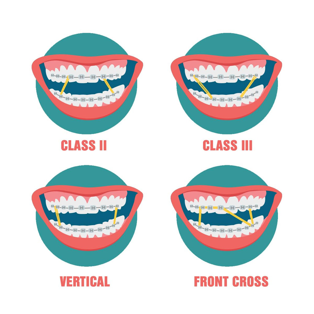 Orthodontic Intraoral Elastics - 10 bag x 1000pcs - Heavy 1/4" 6.5 oz – 6.4mm, Surgical Latex - 1000pcs, Dental natural material - Made in USA - Orthodentalusa Corp.