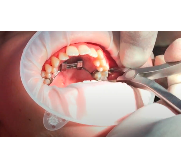 Bonded Expander Remover Plier with Serrated Pad